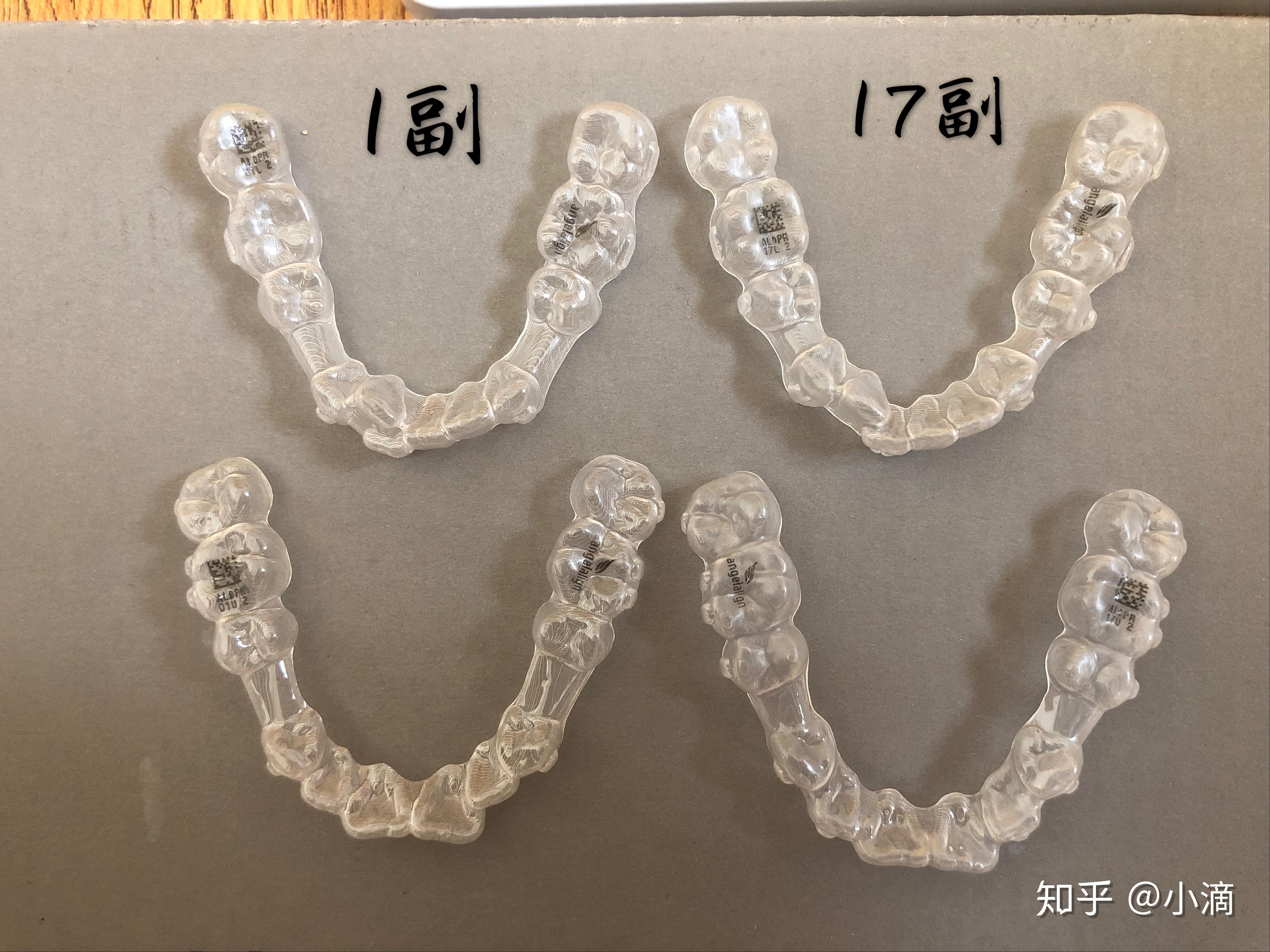 時代天使牙套價格揭秘，小巷中的美麗蛻變之旅啟動！